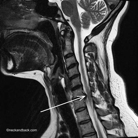 Lateral Cervical MRI of Disc Herniation | Dr Donald Corenm… | Flickr