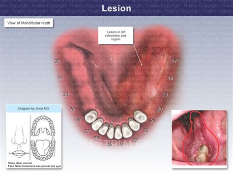 Retromolar Pad Anatomy