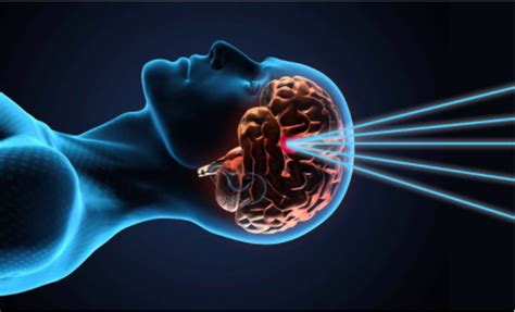 Radiosurgery: Methods and Limitations — Parametric Studio Inc.