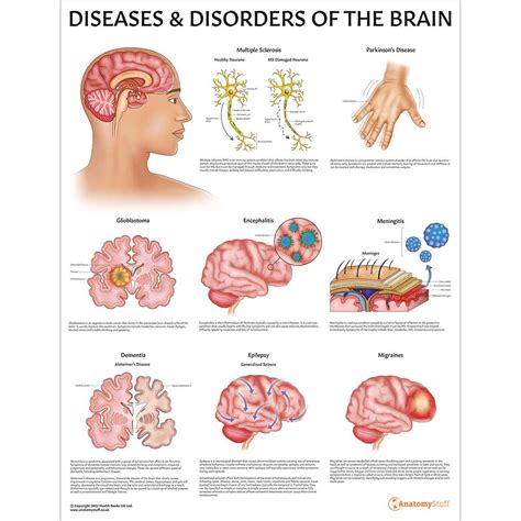 Diseases & Disorders of the Brain Poster | Brain Disorders Chart