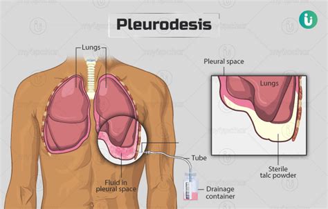 Pleurodesis: Procedure, Purpose, Results, Cost, Price