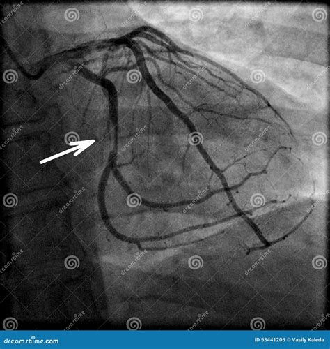 Coronary Artery Disease Stock Image | CartoonDealer.com #70379557