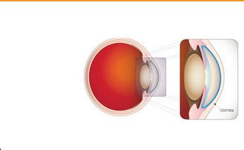 Cornea Eye Surgery at best price in Patna | ID: 18981946797