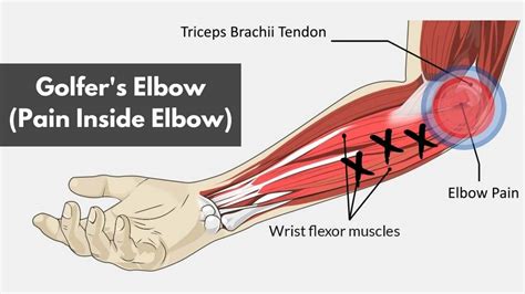 Golfer's Elbow (A Helpful Guide) - TitaniumPhysique