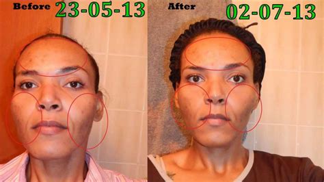 My Bad Acne Scars Honey Skin Care Experiment Part 2 Daily Before and ...