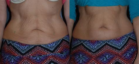 Skin Tightening Abdomen - RejuvaYou Medical