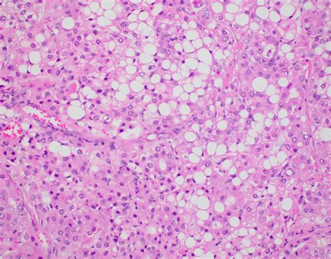 Hepatocellular Carcinoma Histology