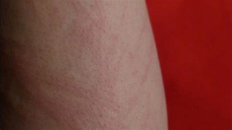 Skin Cancer Rash Symptoms