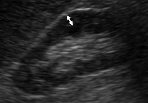 Renal Cortical Thickness Measured at Ultrasound: Is It Better Than ...