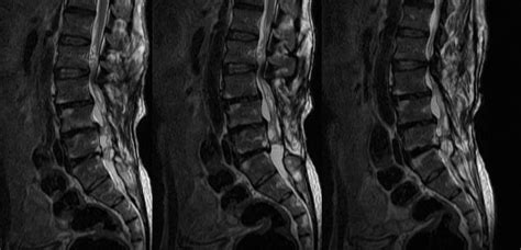 Neuroradiology Cases: Arachnoiditis MRI Lumbar spine