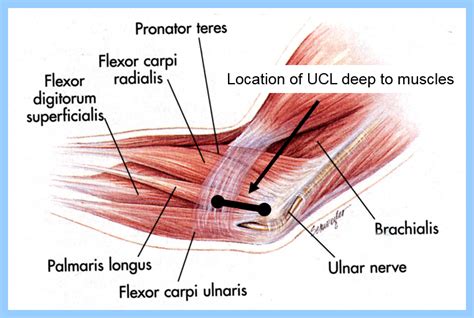 Tommy John Surgery Requires Perfect Tunnel Position for Success