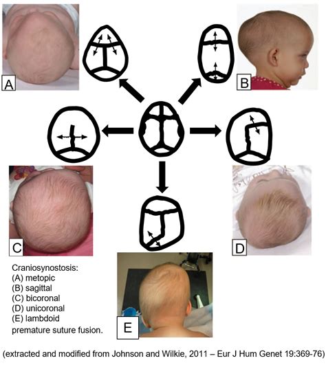 Craniosynostosis – Moazen Lab