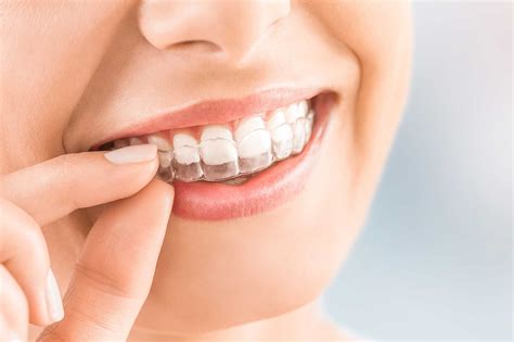 Invisalign Invisible Braces Family Dental Care UK- ChessingtonFamily Dental Care UK Dental ...