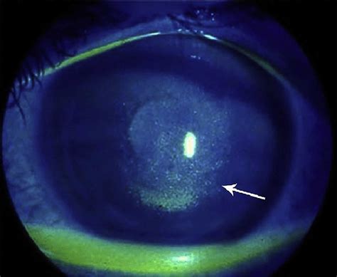 Keratoconjunctivitis, causes, symptoms, diagnosis, treatment & prognosis