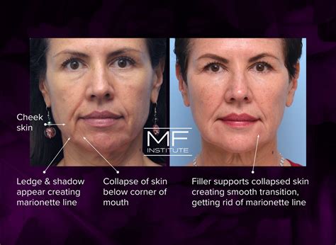 Before and After Marionette Lines Filler: A Photo FAQ | Mabrie Facial ...