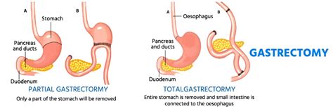 Subtotal Gastrectomy