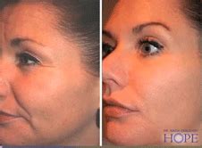 The Sweetheart Face - Using Lasers and Fillers for a Very Natural Look ...