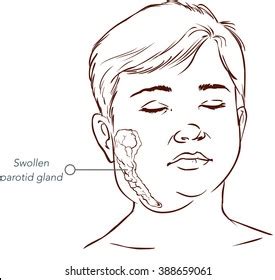 Children Salivary Gland Swelling Vector Illustration Stock Vector ...