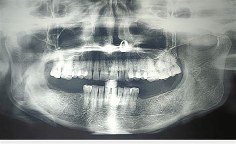 Postoperative OPG in the sixth month reveals a mixed... | Download ...