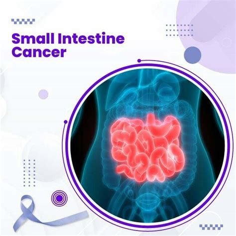 Small Intestine Cancer , Signs and Symptoms | Uhapo