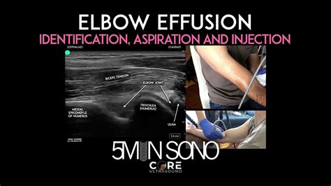 Elbow Effusion - Identification, Aspiration and Injection - YouTube