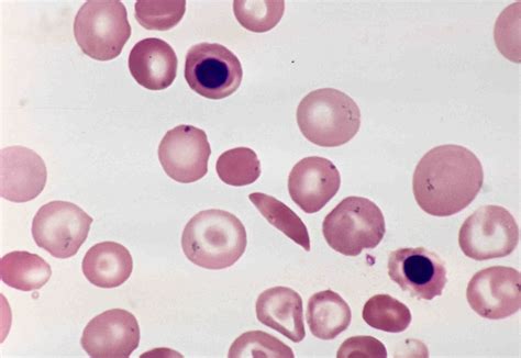 Why do you see Howell-Jolly bodies in sickle cell anemia? | Pathology ...