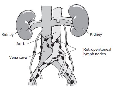 About Your Retroperitoneal Lymph Node Dissection | Memorial Sloan Kettering Cancer Center