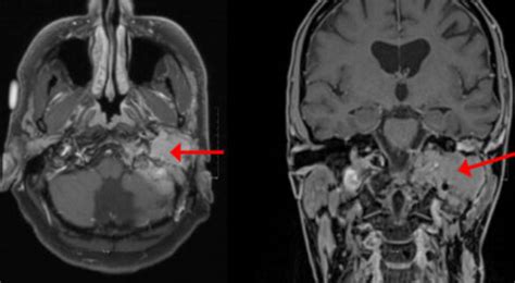 PARAGANGLIOMA - Longhorn Brain and Spine