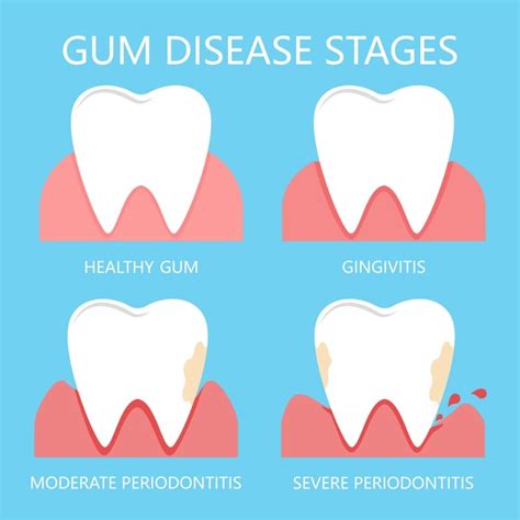 What Are the Stages of Periodontal Disease? | SD Perio