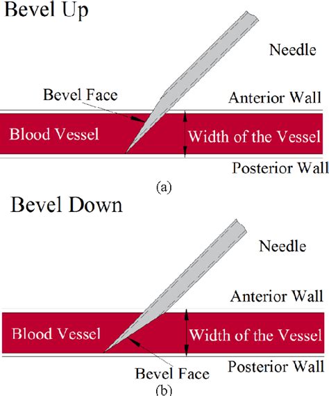 Figure 1 from Investigation of Needle Bevel Face Up and Down Orientation on Pediatric ...