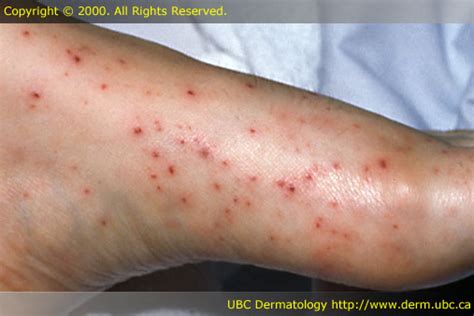 Petechiae. Causes, symptoms, treatment Petechiae