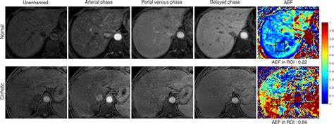 Liver fibrosis: Review of current imaging and MRI quantification ...