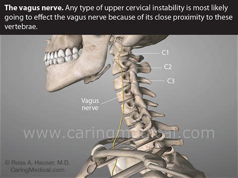 Small intestinal bacterial overgrowth and the Vagus nerve. The problem of nerve compression ...