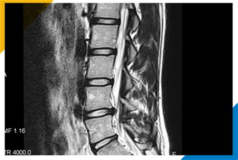 Pittsburgh CT: Answers About Contrast Dye