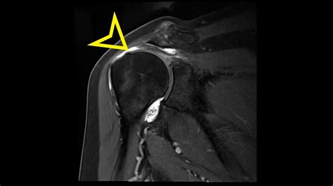 Shoulder MRI: Supraspinatus Tear With Tendon Retraction - YouTube