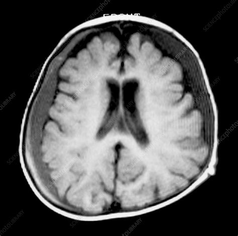 MRI of Subdural Hematomas - Stock Image M136/0327 - Science Photo Library