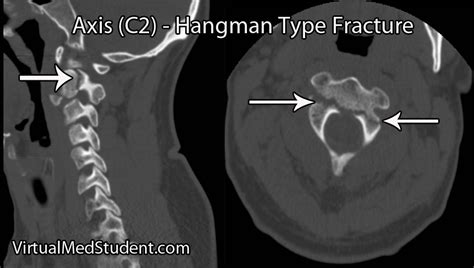 The Hangman’s Fracture - VirtualMedStudent.com