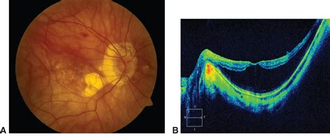 Myopic macular degeneration - American Academy of Ophthalmology