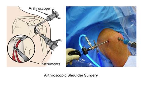 Labral Tears | Dr Pant - Sydney Shoulder Unit