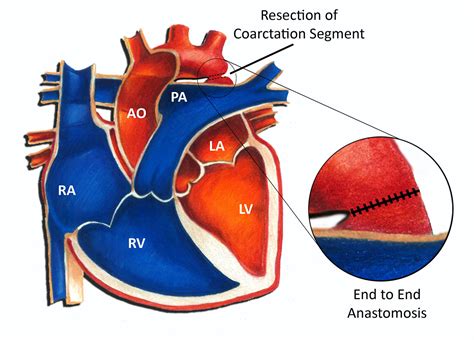 Coarctation of the Aorta - Surgical Repair - Pediatric Heart Specialists