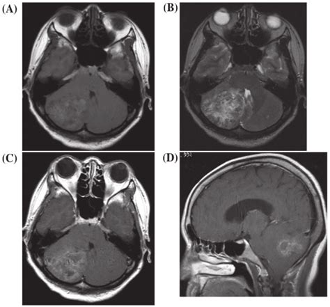 preoperative magnetic resonance imaging (MRI) showing a lesion in the... | Download Scientific ...