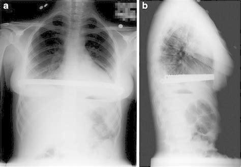 Normal postoperative Nuss bar with horizontal orientation on both (a)... | Download Scientific ...