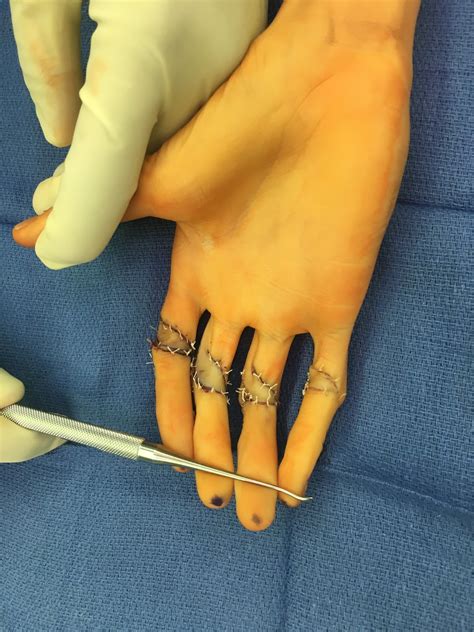 Camptodactyly Unusual Cause Congenital Hand And Arm D - vrogue.co