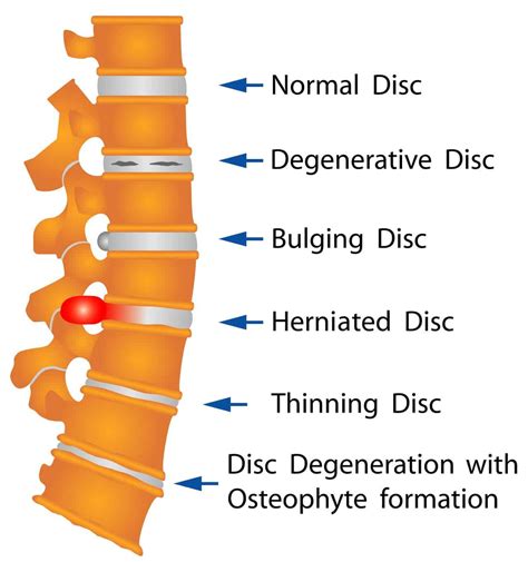 What are the Causes and Symptoms of a Disc Herniation? - Advanced Chiropractic Spine & Sports ...