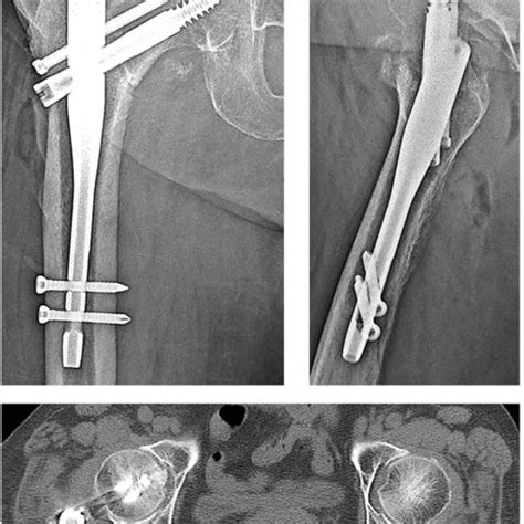 Right basicervical femoral fracture. | Download Scientific Diagram