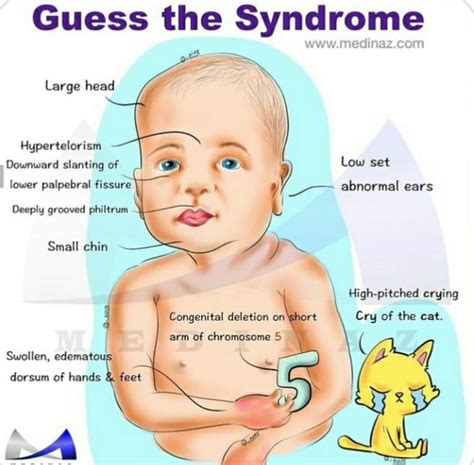 Cri Du Chat Syndrome Causes Of Cat's Cry Syndromes, 60% OFF