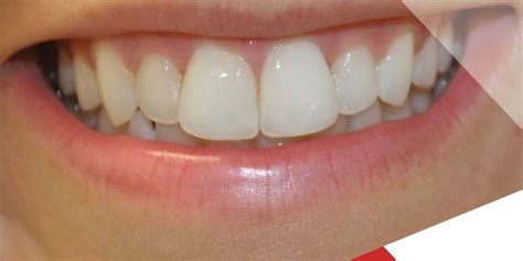 What are solutions to Big Teeth? | Smile teeth, Big teeth, Dental clinic