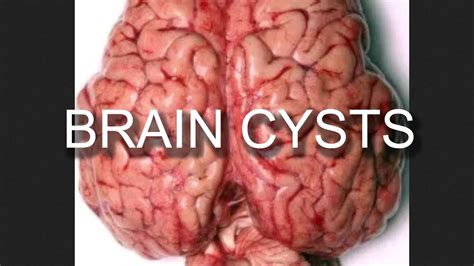 Brain Cyst Removal (Arachnoid Cyst) Everything You Need to Know - YouTube