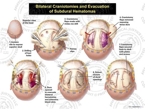 Bilateral Craniotomies and Evacuation of Subdural Hematomas