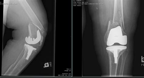 Periprosthetic Fracture Classification